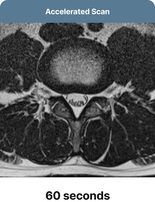 Accelerated MRI scan at 60 seconds