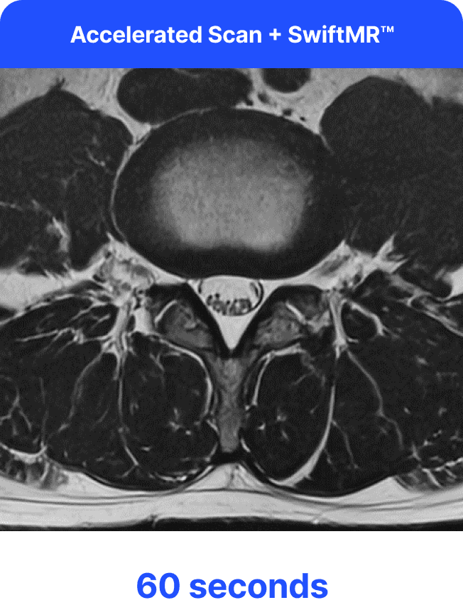 Accelerated MRI scan with SwiftMR enhancement at 60 seconds