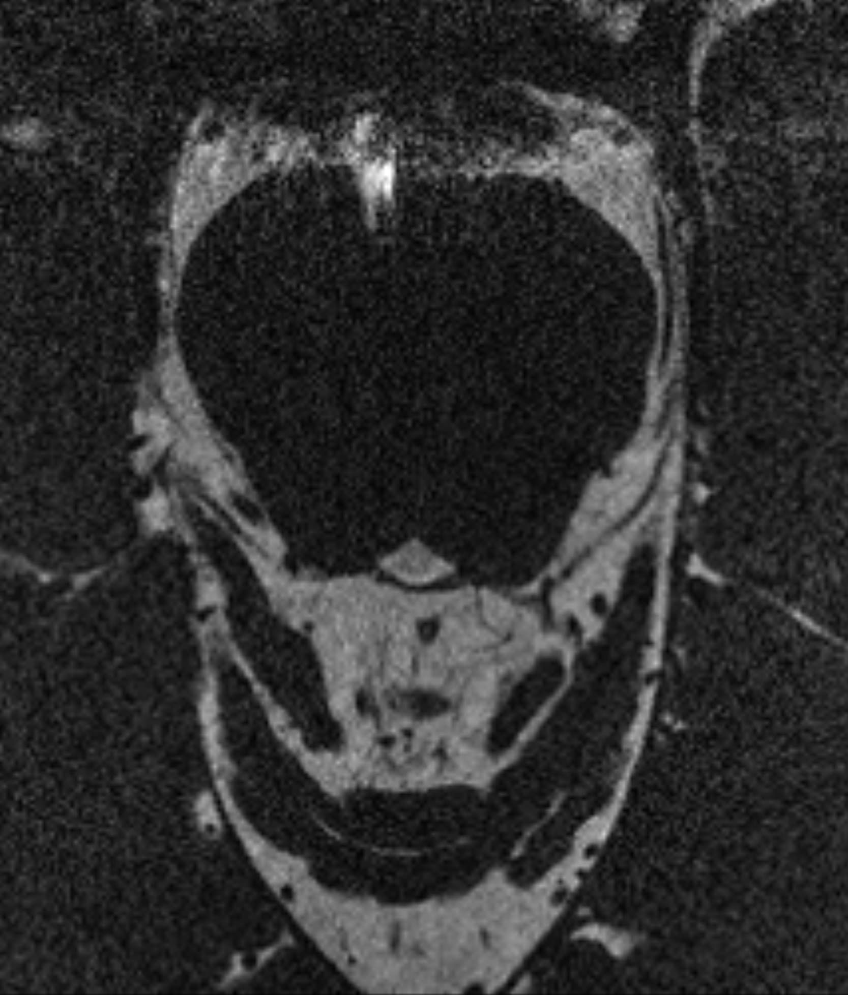 Cranial Nerve T2WI - 3.0T Siemens MAGNETOM Vida - Conventional