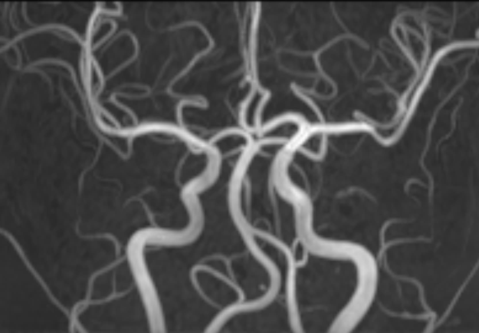 Brain MRA - 3.0T Siemens MAGNETOM Skyra - Conventional