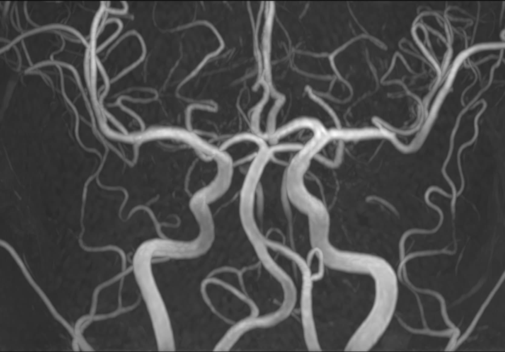 Brain MRA - 3.0T Siemens MAGNETOM Skyra - SwiftMR