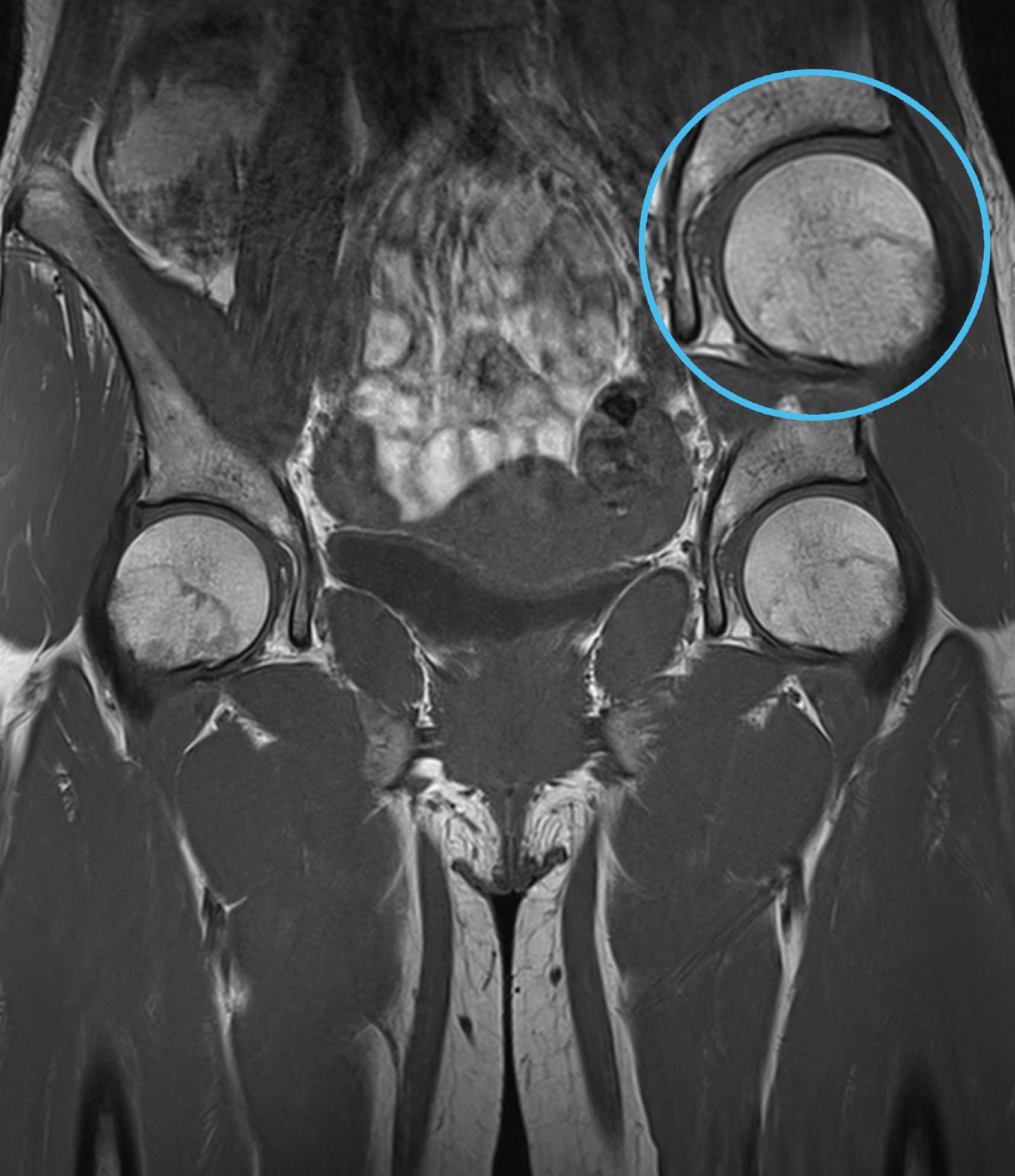 Hip T1WI - 3.0T Siemens MAGNETOM Skyra - SwiftMR